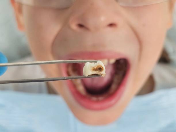 Best Emergency Broken Tooth Repair in Fort Valley, GA